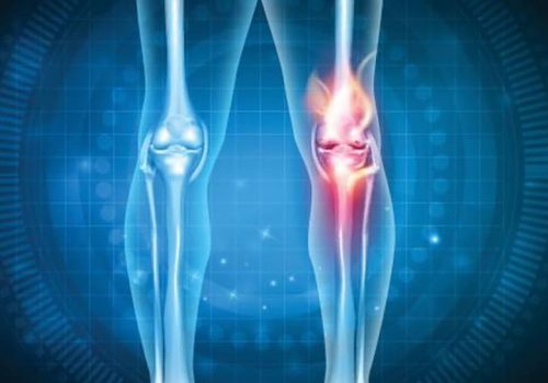 Avances de la medicina Regenerativa en la osteoartritis de rodilla